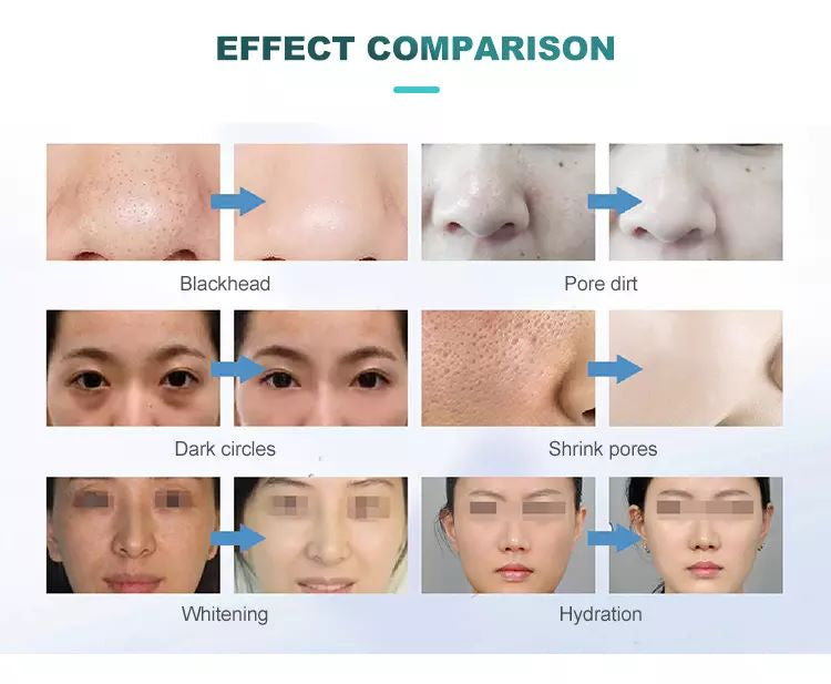 SLyric 7-In-1 Hydro Facial Machine For Deep Cleansing